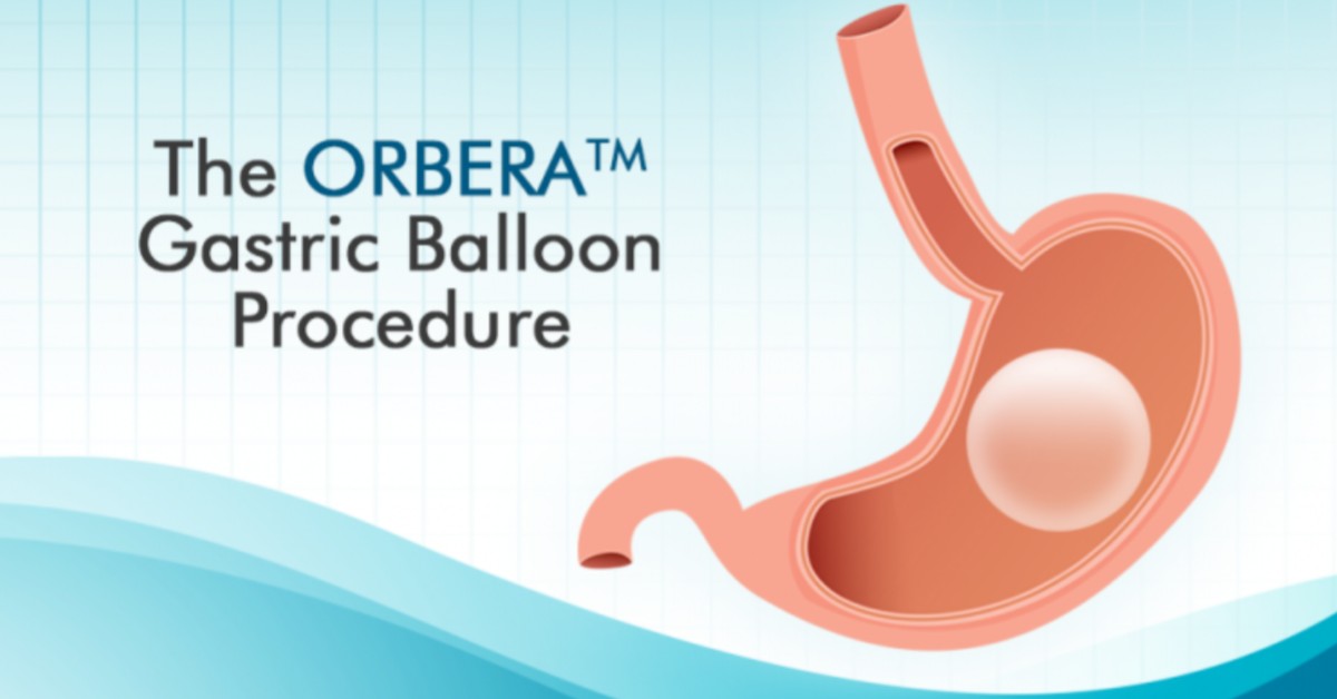 water tijdelijk Paragraaf Orbera Intragastric Balloon FDA Distinction: Anchorage Bariatrics