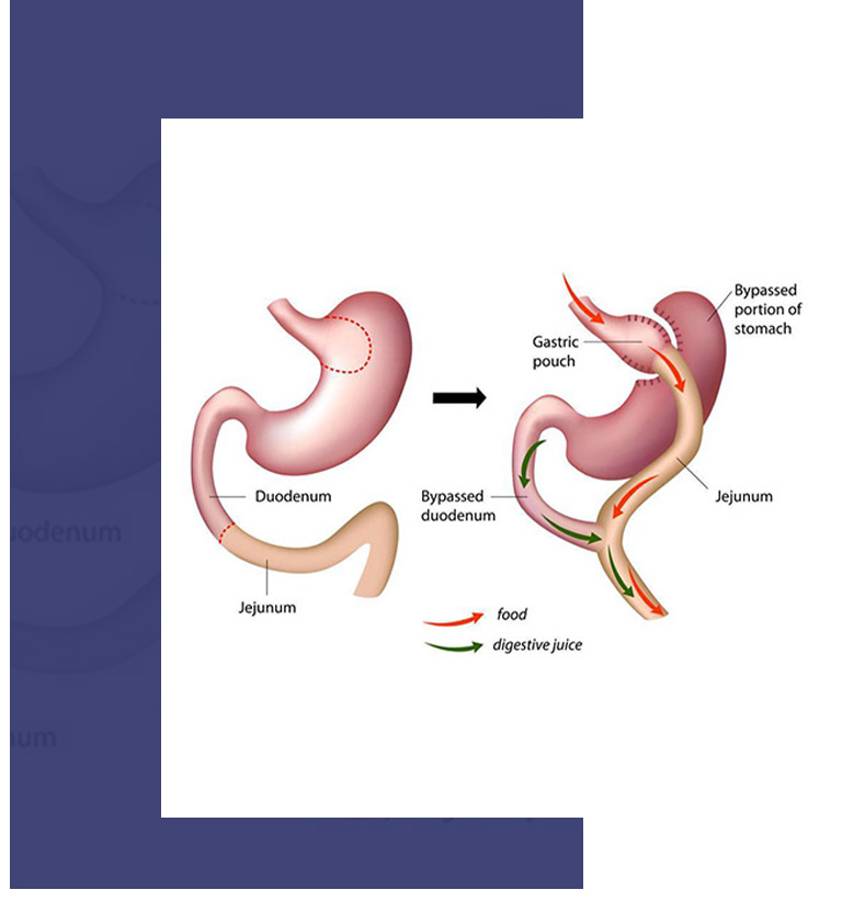 What Is a Gastric Bypass?